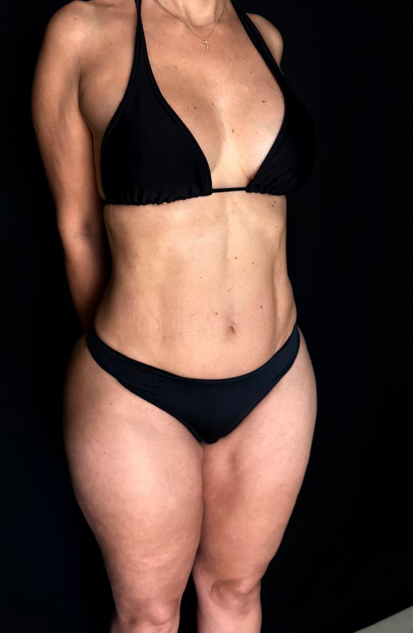 Lipoaspiração Ultra HD com escultura da silhueta frontal